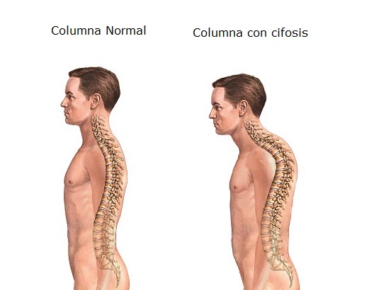 Columna normal vs Cifosis
