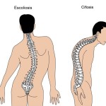 Si se pierde el peso a la osteocondrosis