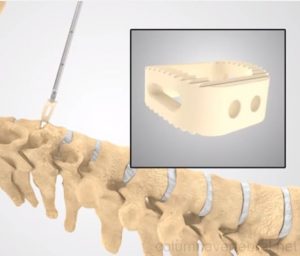 La artrodesis vertebral,  es un tipo de cirugía cuya función es fusionar dos o más vértebras