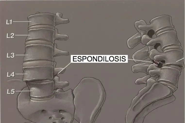 Espondilosis (osteoartritis espinal)