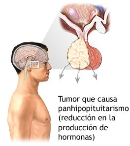 Cuando la glándula pituitaria no produce la hormona del crecimiento, se habla de enanismo pituitario