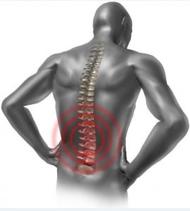 Los síntomas de la espondilosis es dolor en la espalda