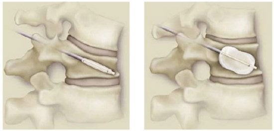 Cifoplastie pentru tratamentul fracturilor coloanei vertebrale