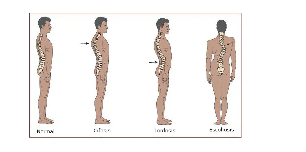 Cifosis Lordosis Escoliosis