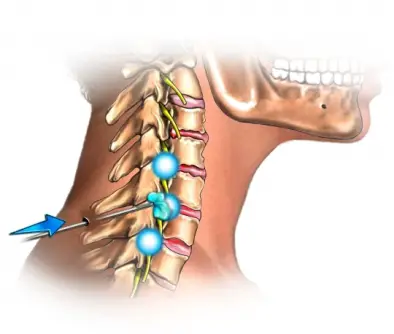 Contractura Cervical