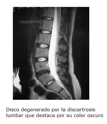 Discartrosis lumbar2