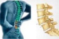 Lumbar spondyloarthrosis