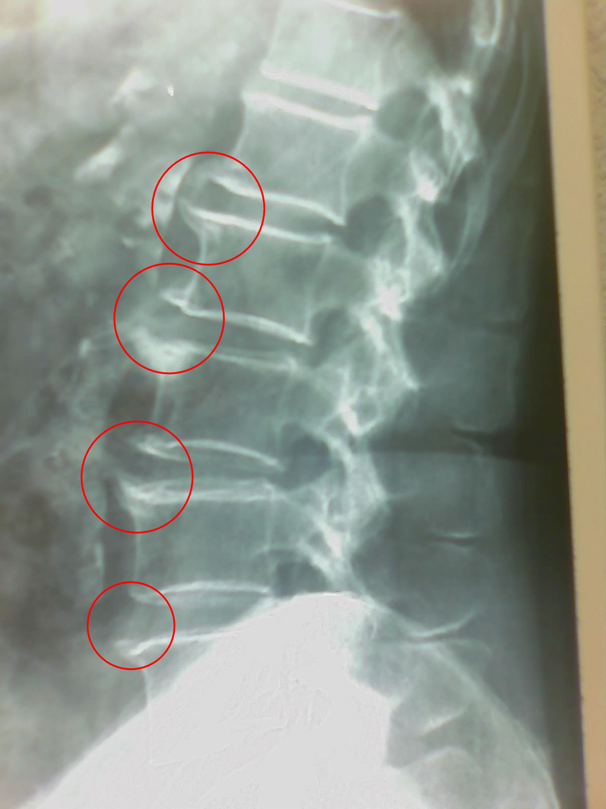 Espondiloartrosis lumbar