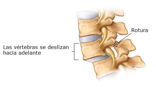 Espondilolistesis