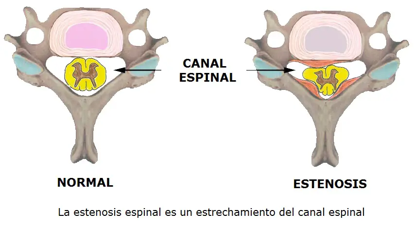 Estenosis Espinal