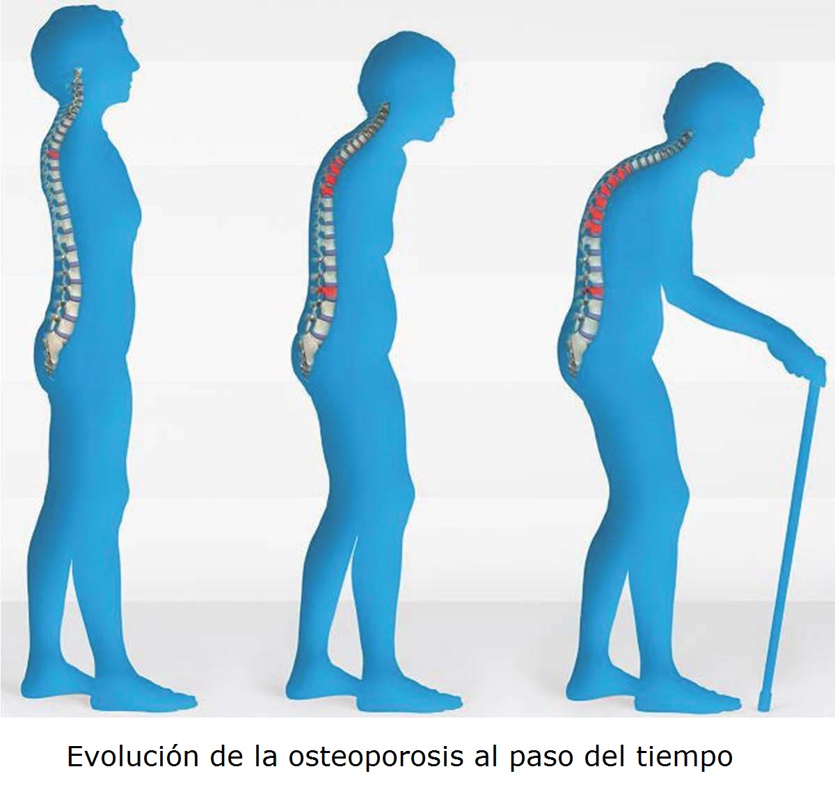 Evolución de la osteoporosis a lo largo de los años