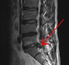 La hernia de disco L4 - L5 es comúnmente conocida como hernia lumbar