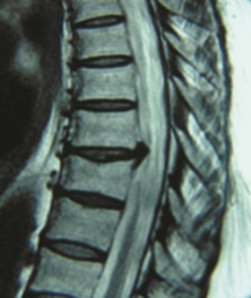 La hernia dorsal del disco L5 S1 se debe a los procesos degenerativos de la columna