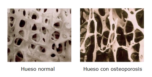 Hueso normal y hueso con osteoporosis