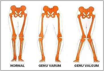 Genu Varo Piernas Arqueadas