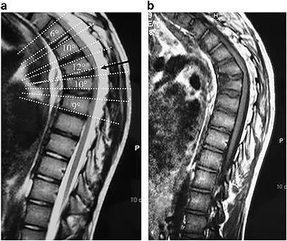 cifosis lumbar juvenil