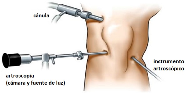 Cirugía artroscópica.