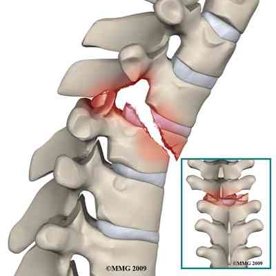 Adult_thoracic_fx_types05