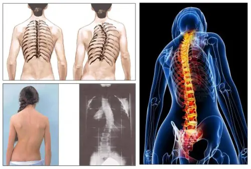 Enfermedades coluimna vertebral