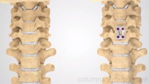 artrodesis-vertebral_