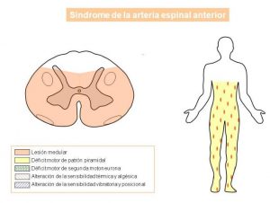 Tratamiento para el Síndrome de Compresión Medular