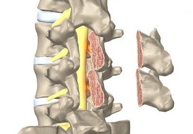 Laminectomy