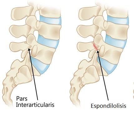 La espondilolisis es una grieta o fractura en una de las vértebras