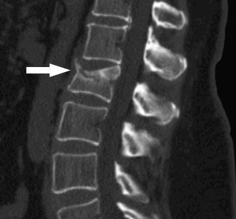 la tomografia de la columna vertebral se realiza cuando los rayos X no son concluyentes.