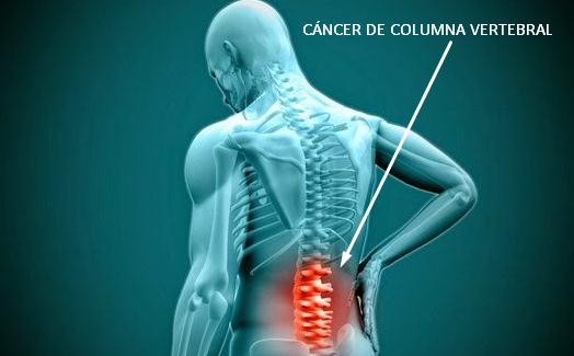 El cáncer de columna vertebral, es un crecimiento celular anormal en las vertebras