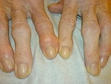 osteofytóza Může být patrná, V některých případech se prezentují “zauzlované prsty”. 