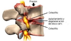 Tratamiento de la osteofitosis en la columna vertebral