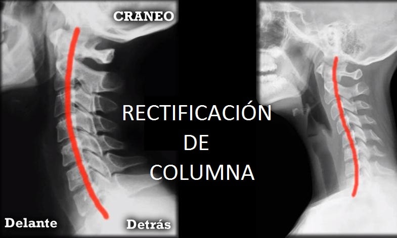 La rectificación de columna aparece comúnmente en la zona lumbar y cervical