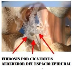 La fibrosis epidural es causada como consecuencia de una cirugía de la espalda