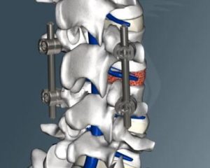 la fusión espinal como tratamiento para la inestabilidad lumbar