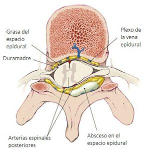los abscesos epidurales espinales aparecen en las regiones torácicas o lumbares