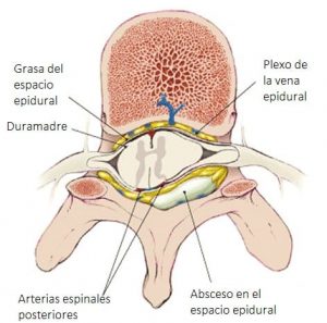 ကျောရိုး epidural ပြည်တည်နာများသည် thoracic ဒေသများတွင်ပေါ်လာသည်။ácycads သို့မဟုတ် lumbars