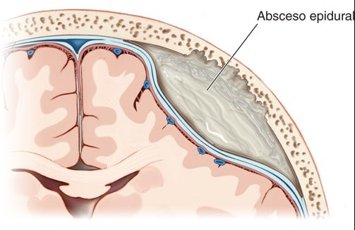 Un absceso epidural es una inflamación producida por una acumulación de material purulento