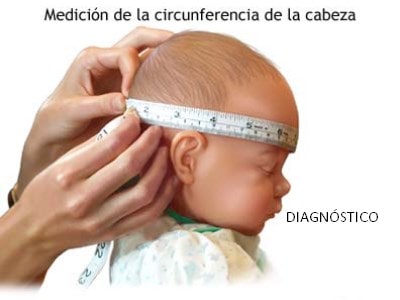 El diagnóstico de la microcefalia se puede realizar  después del nacimiento