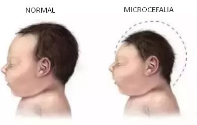 La microcefalia es una patología del desarrollo del cráneo