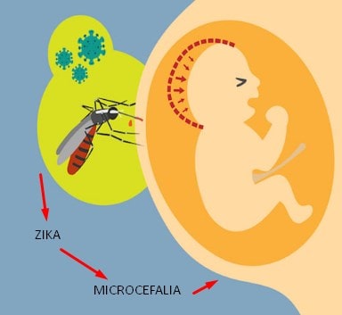 La microcefalia Puede ser causado por infecciosas de la madre como Zika o toxoplasmosis