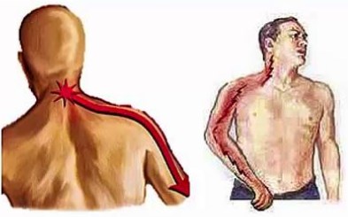 La discopatía degenerativa puede presentarse en el cuello y extenderse hasta el brazo 