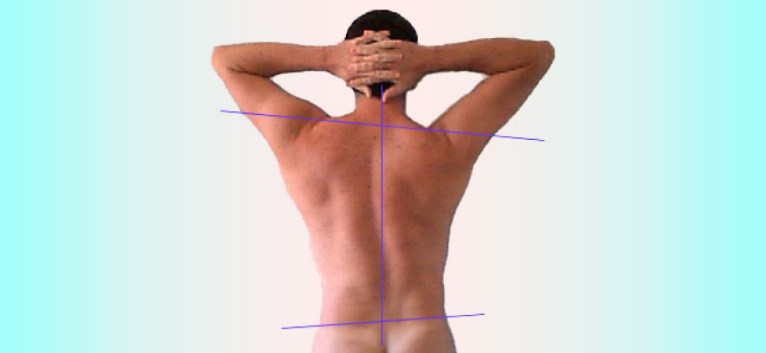 A escoliose lombar é um desvioón lateral do eixo vertical da coluna vertebral