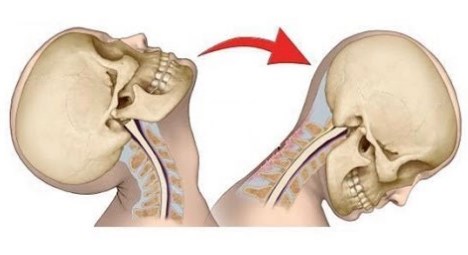 El mareo cervical es el resultado de una lesión en la cabeza