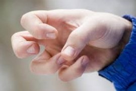 Las manos adormecidas son un síntoma de la mielopatía cervical