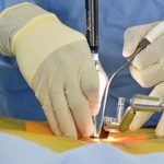 La cirugía abierta es una opción de tratamiento para la protusión discal