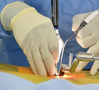 La cirugía abierta es una opción de tratamiento para la protusión discal