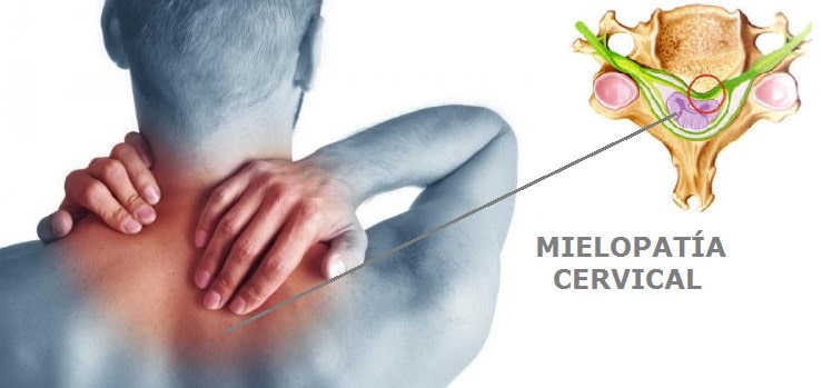 La mielopatía cervical resulta de una compresión severa en la médula espinal