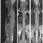 Diagnosztikai méspondylosis orvos