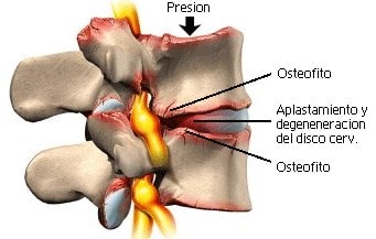 De oarsaken fan spondylose binne relatearre oan leeftyd