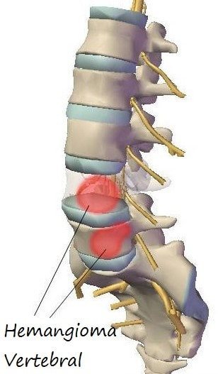  hemangioma espinal